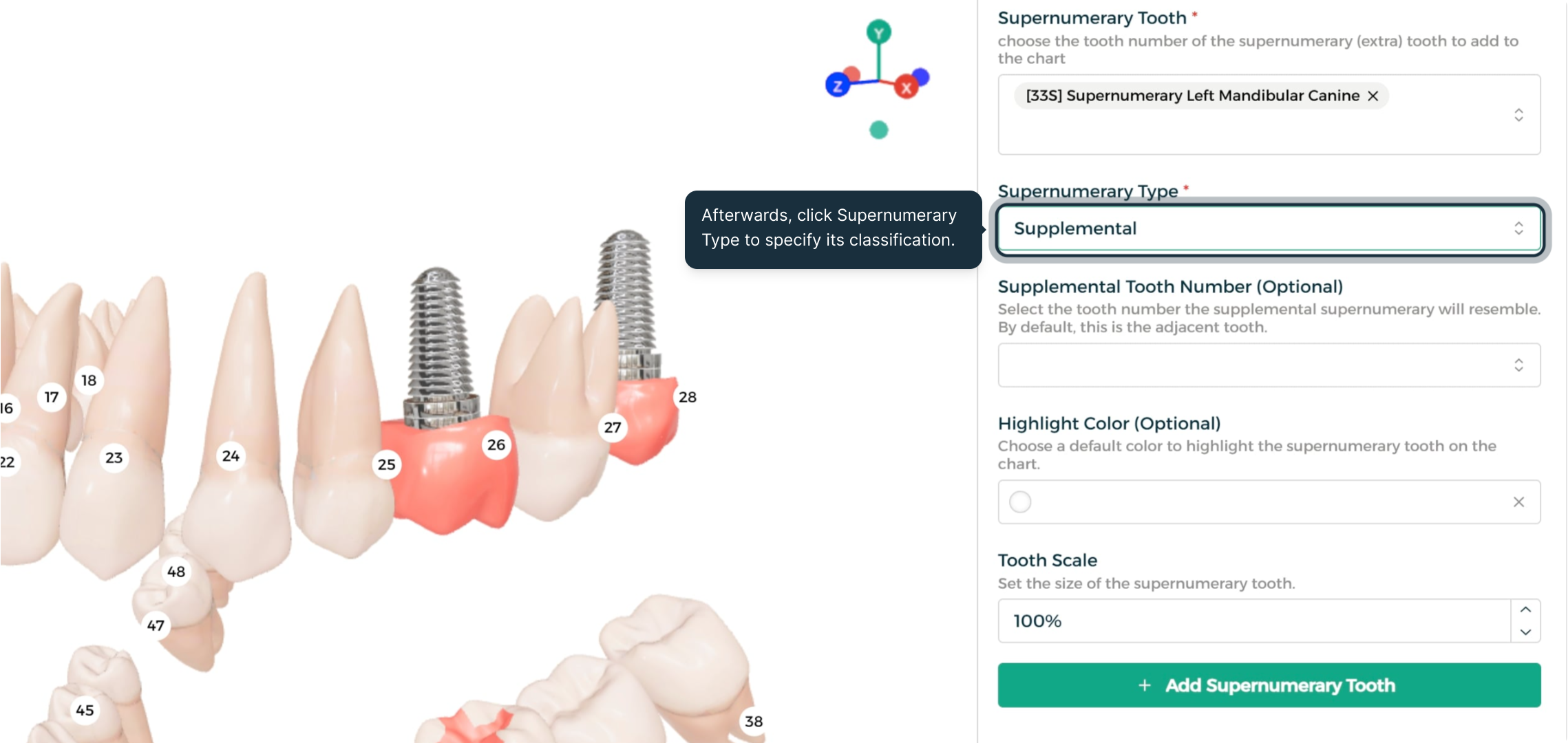 Step 3 - Set the supernumerary type